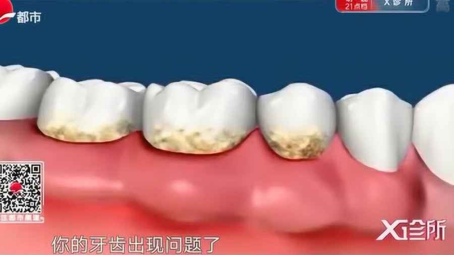 最新牙齿清洁技术，步骤指南与实际应用解析