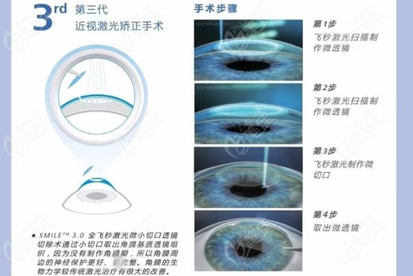 激光手术治近视眼的全面解析、价格一览及案例分享